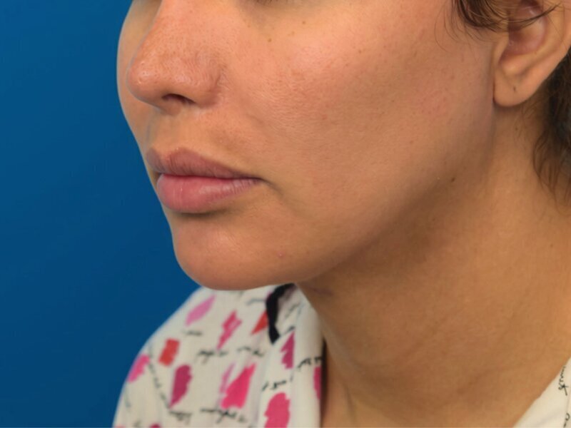 Augmentation Genioplasty Before & After Image