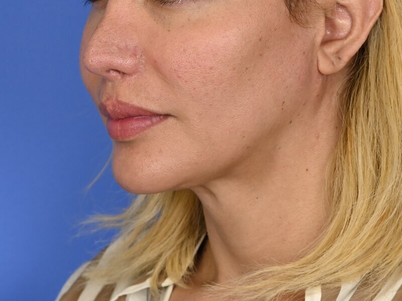 Augmentation Genioplasty Before & After Image