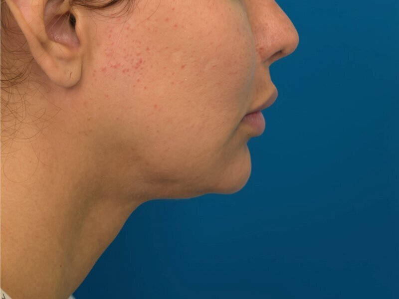 Augmentation Genioplasty Before & After Image