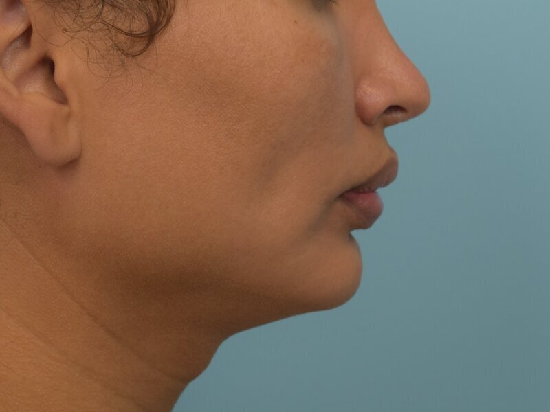 Augmentation Genioplasty Before & After Image