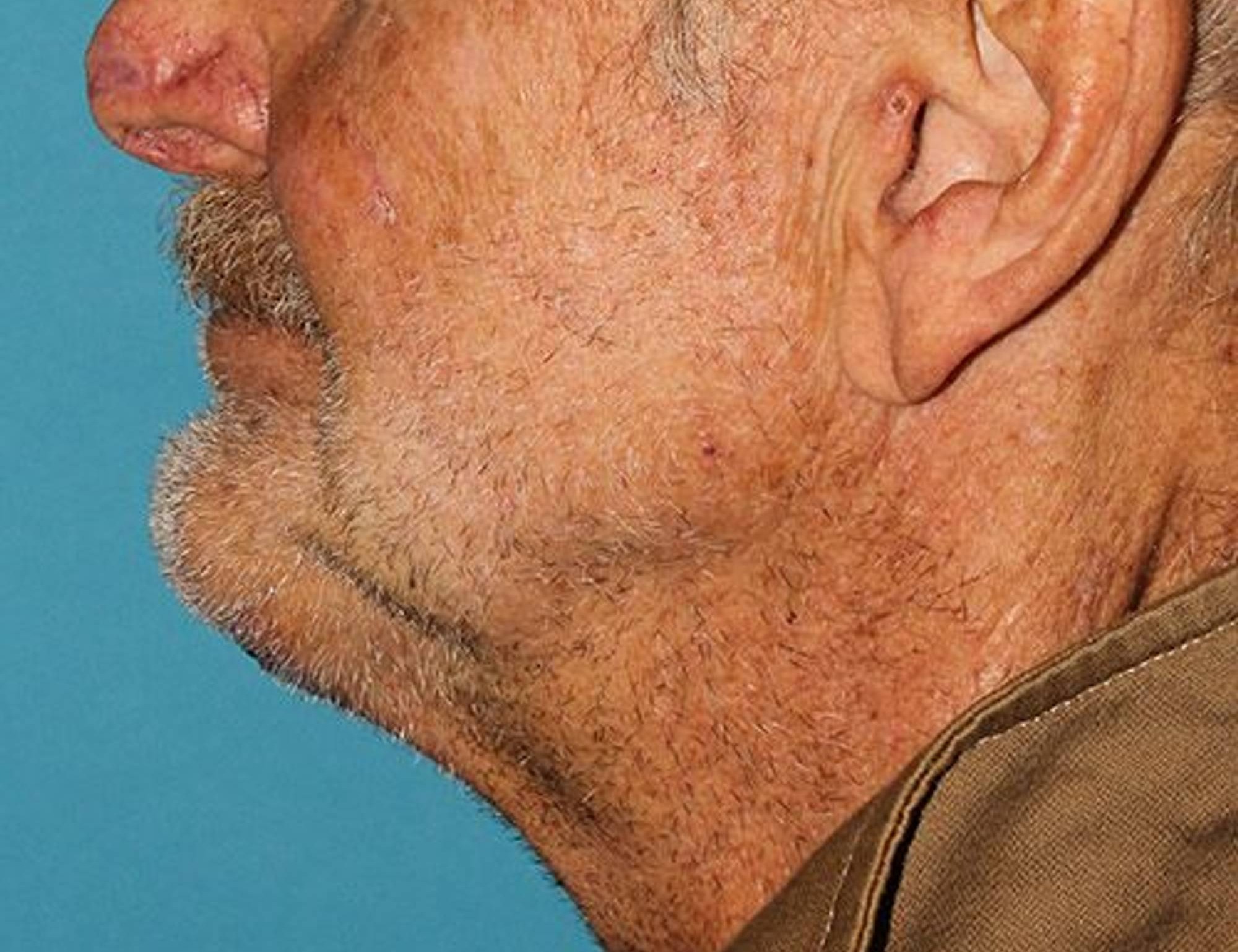 Chin Implants Before & After Image