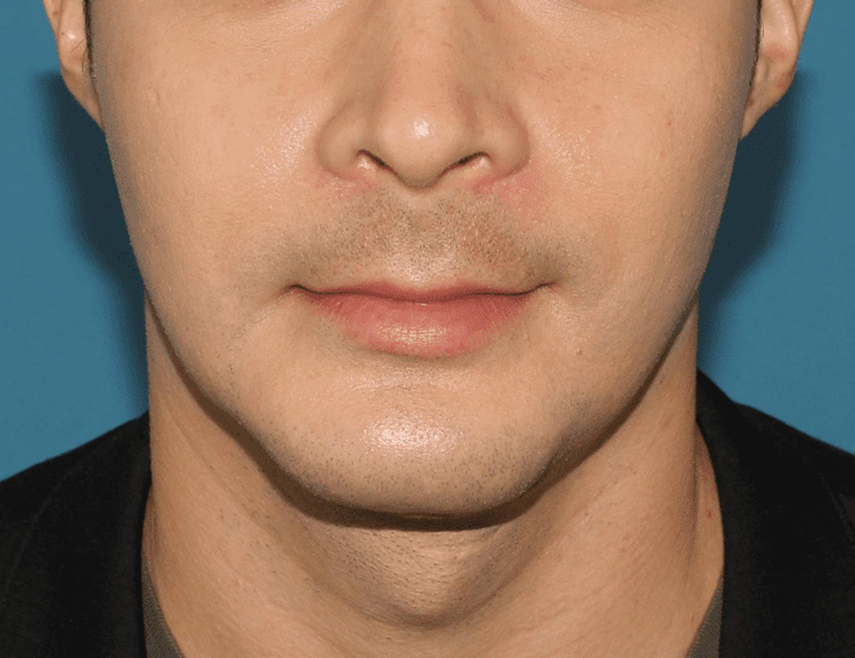 Chin Implants Before & After Image