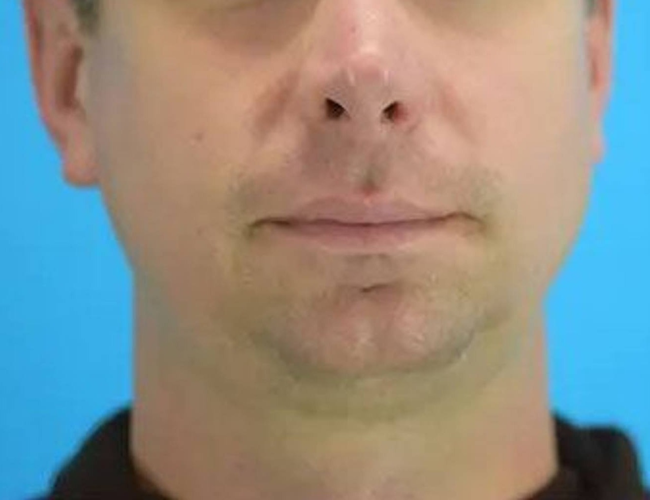 Chin Implants Before & After Image