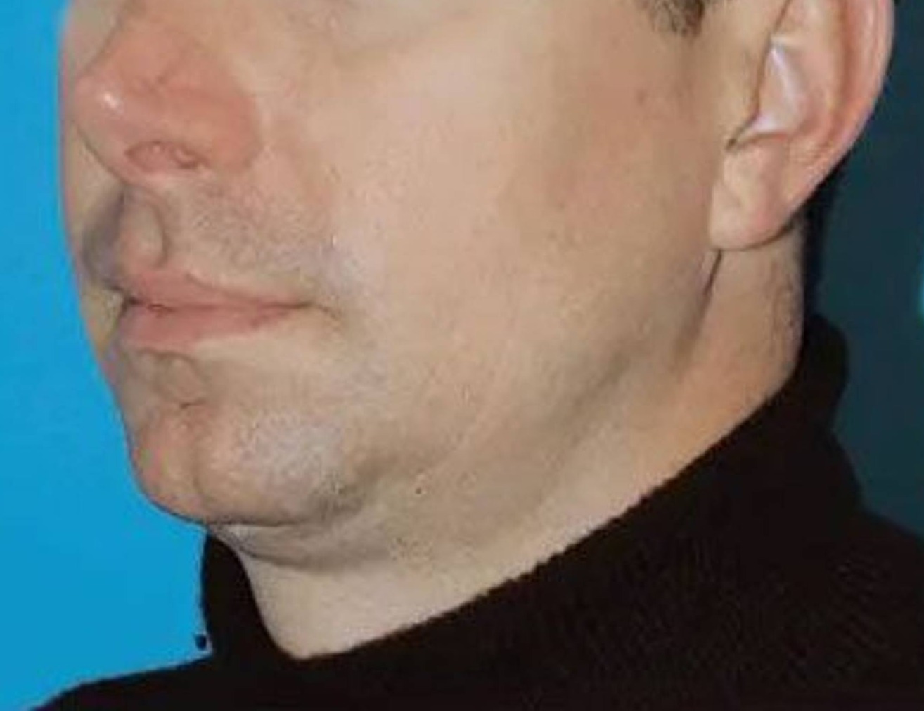 Chin Implants Before & After Image