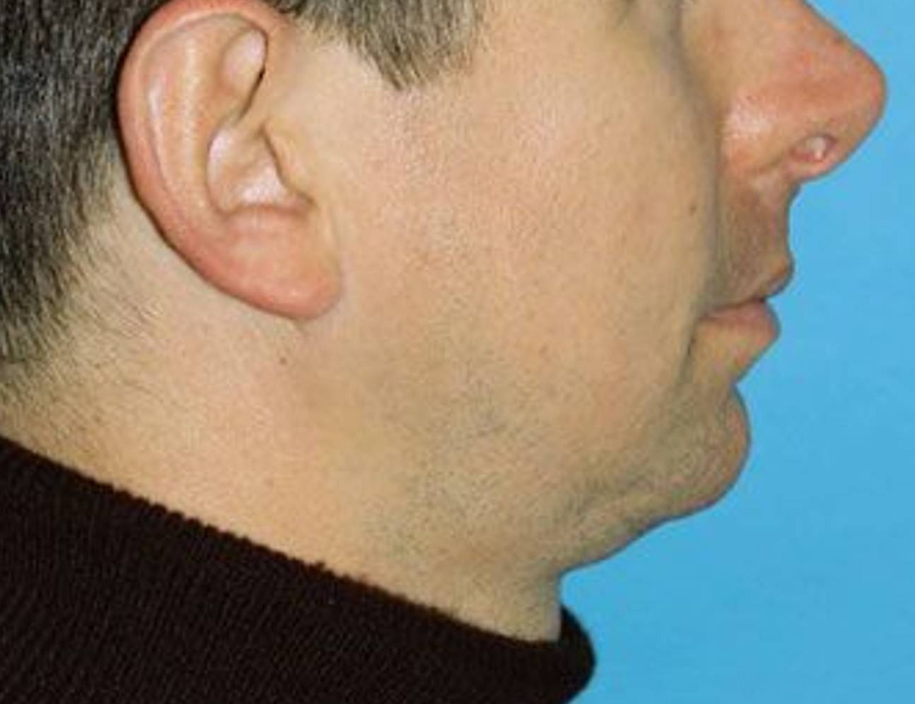 Chin Implants Before & After Image