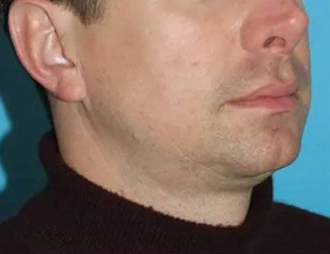 Chin Implants Before & After Image