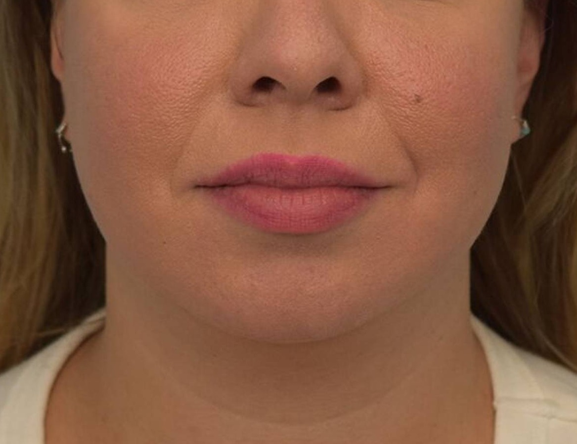 Chin Implants Before & After Image