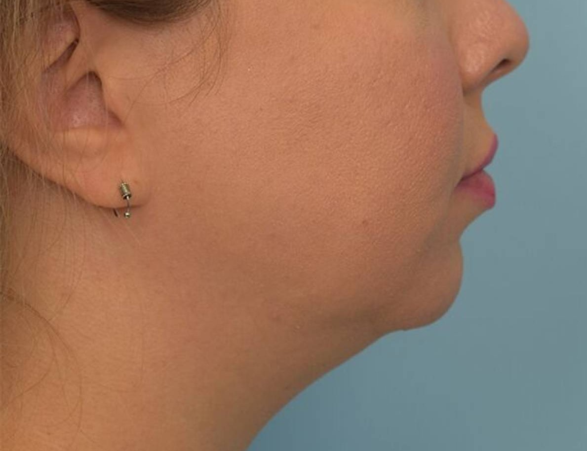 Chin Implants Before & After Image