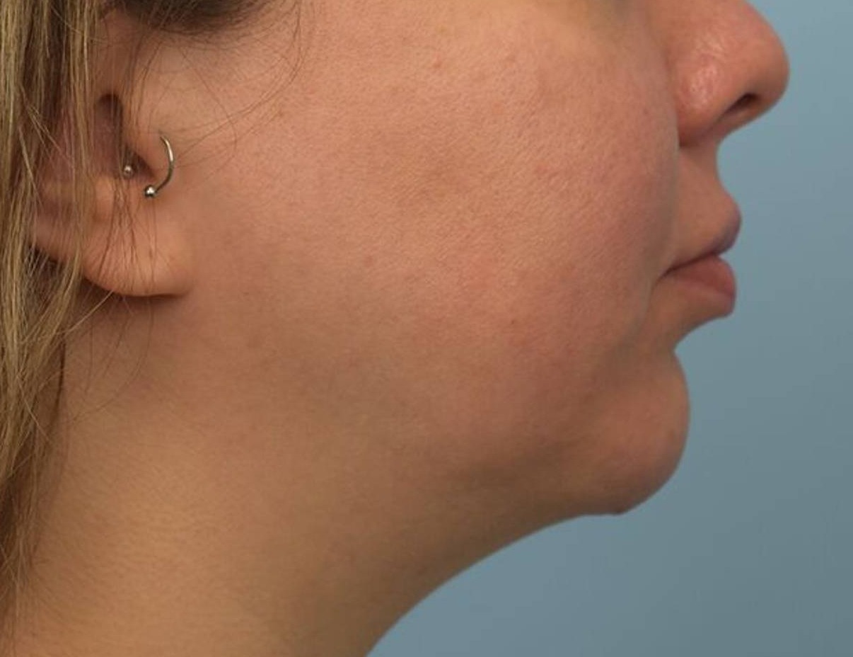 Chin Implants Before & After Image