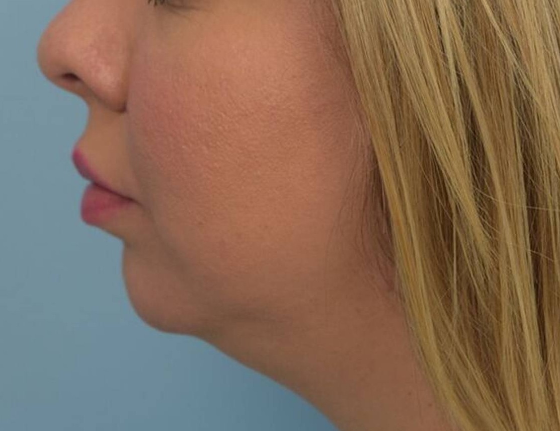 Chin Implants Before & After Image