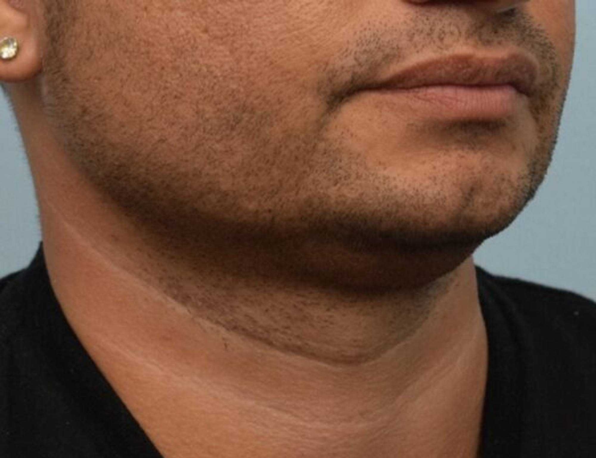 Chin Implants Before & After Image