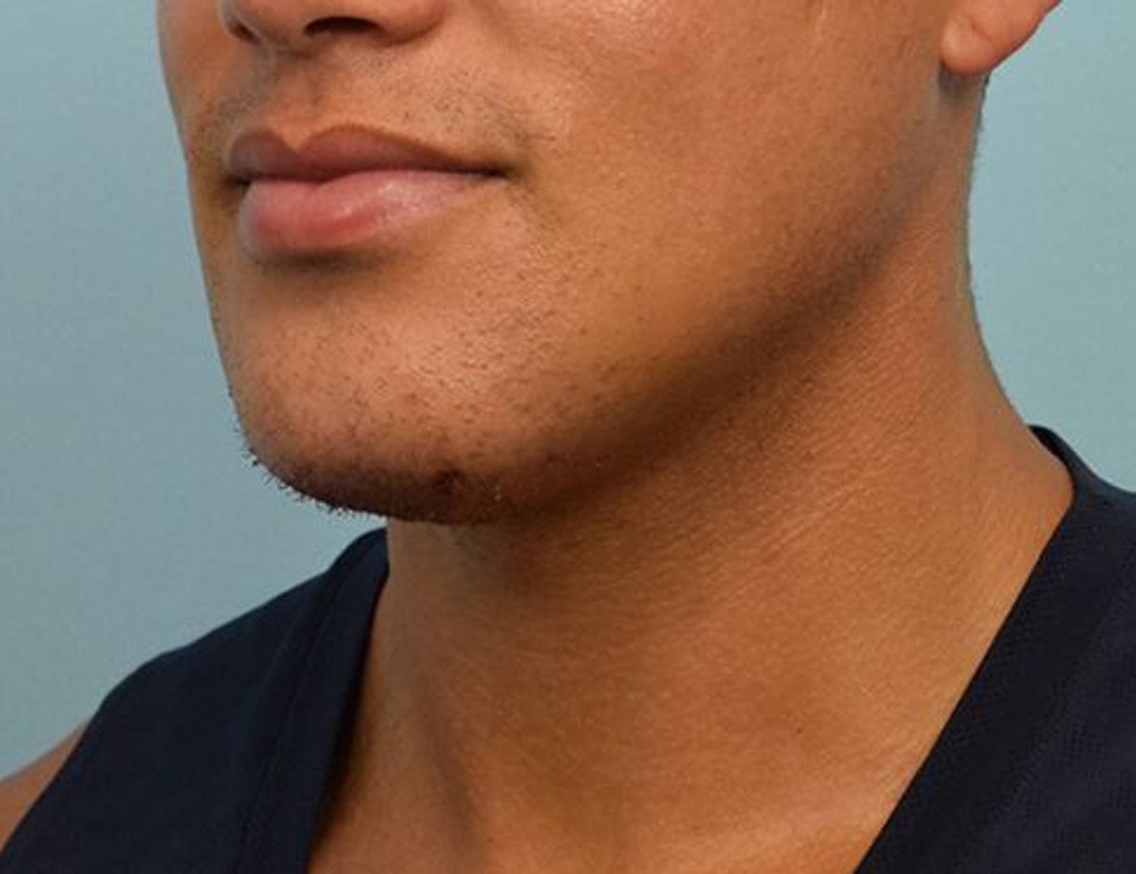 Chin Implants Before & After Image