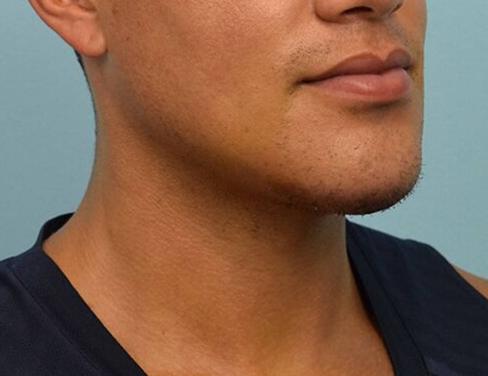 Chin Implants Before & After Image