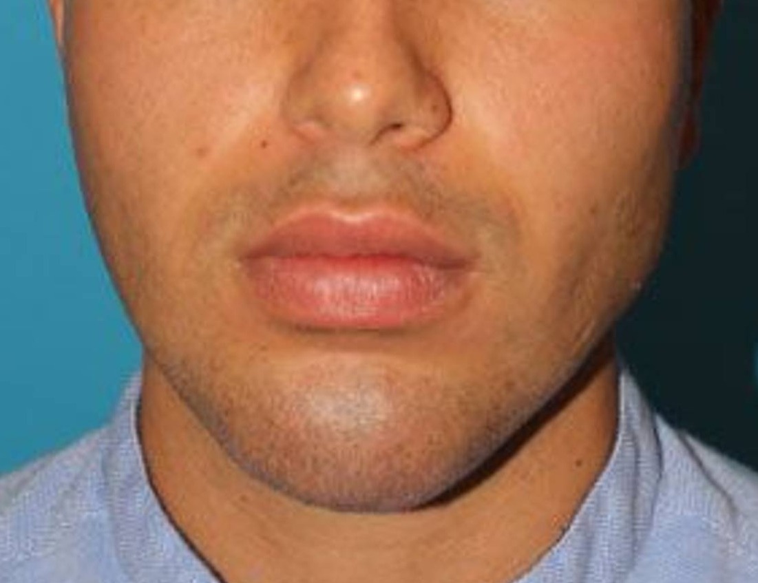 Chin Implants Before & After Image