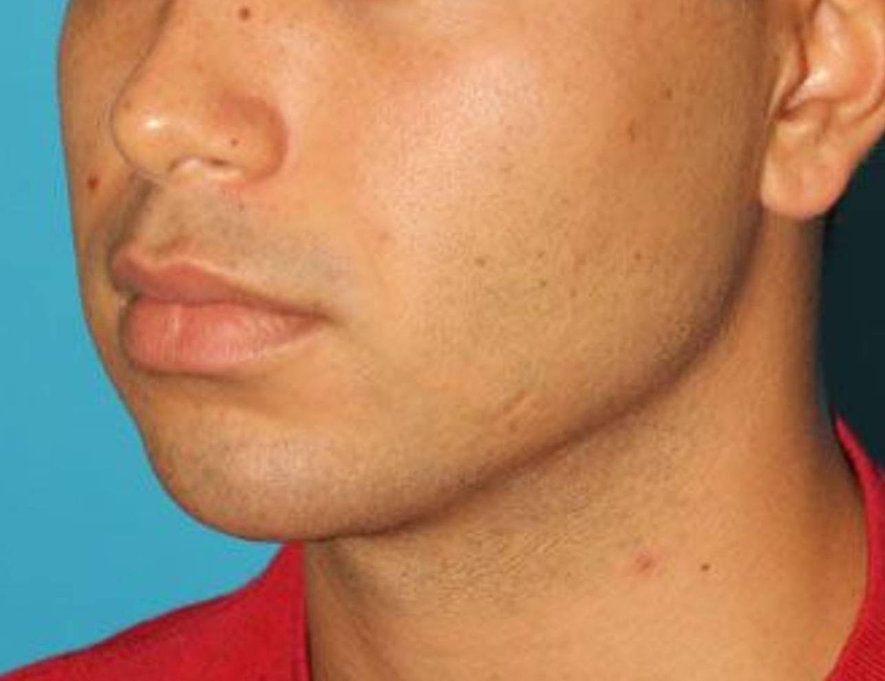 Chin Implants Before & After Image