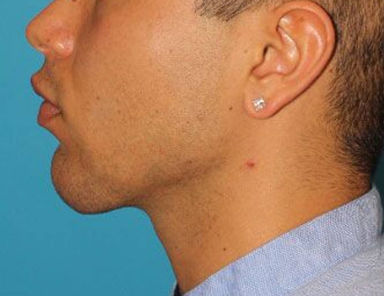 Chin Implants Before & After Image