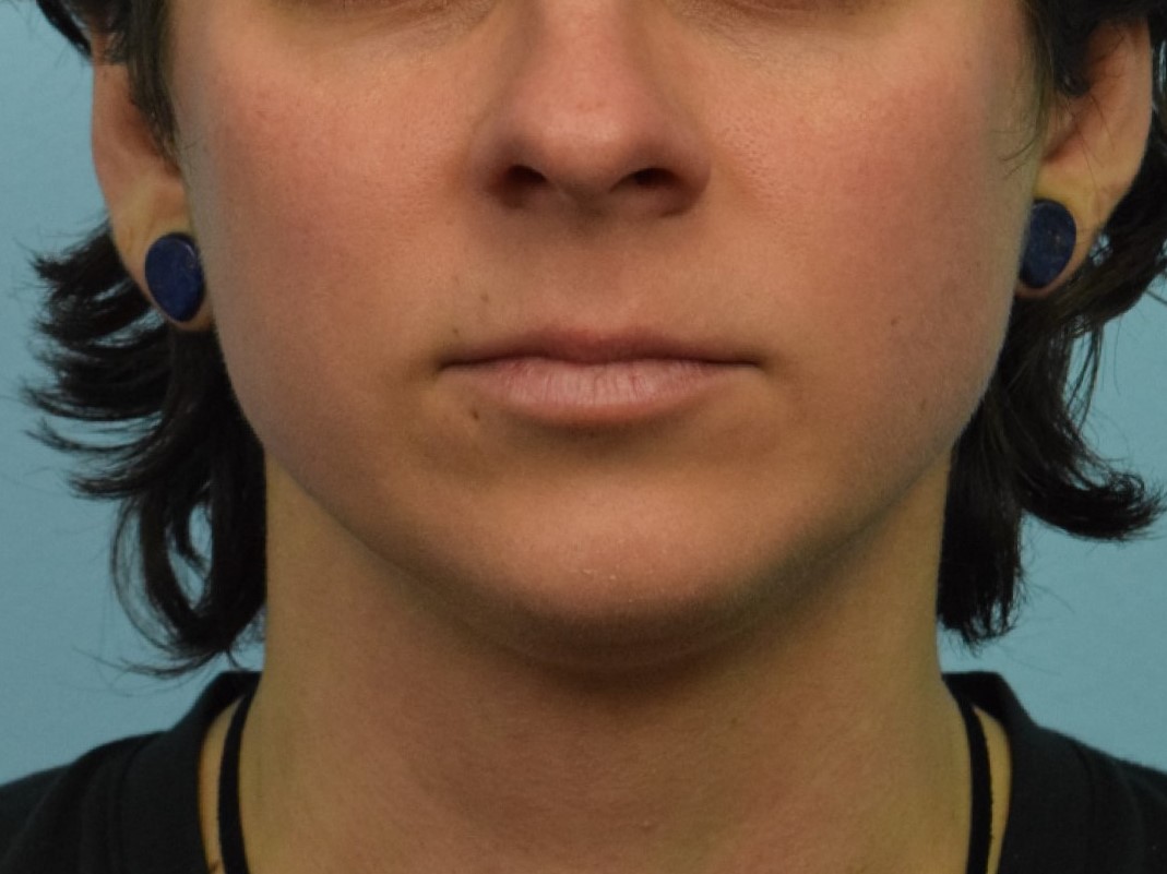 Chin Implants Before & After Image