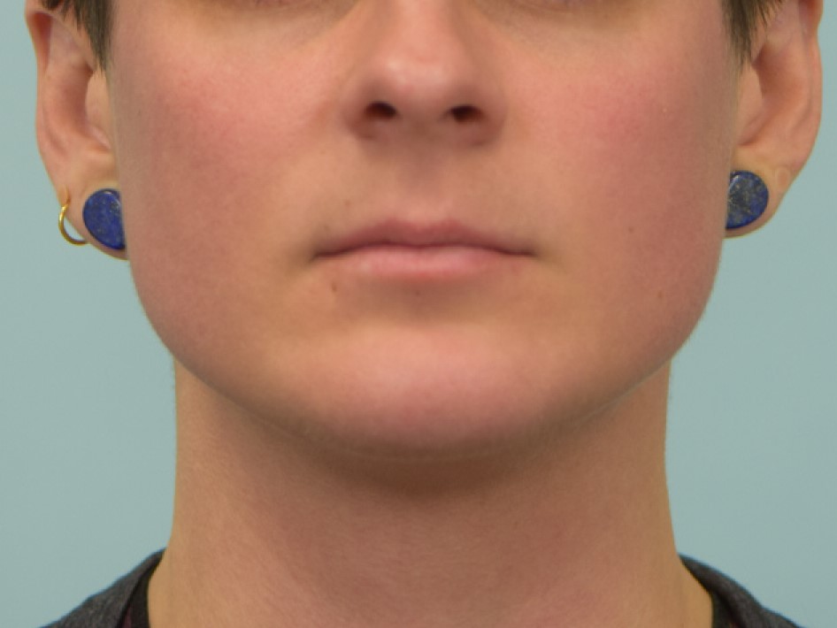 Chin Implants Before & After Image