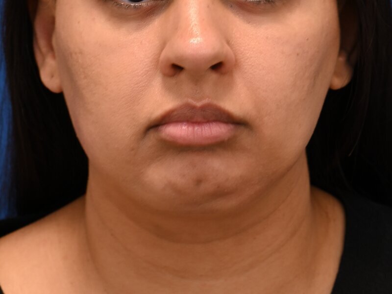 Chin Implants Before & After Image