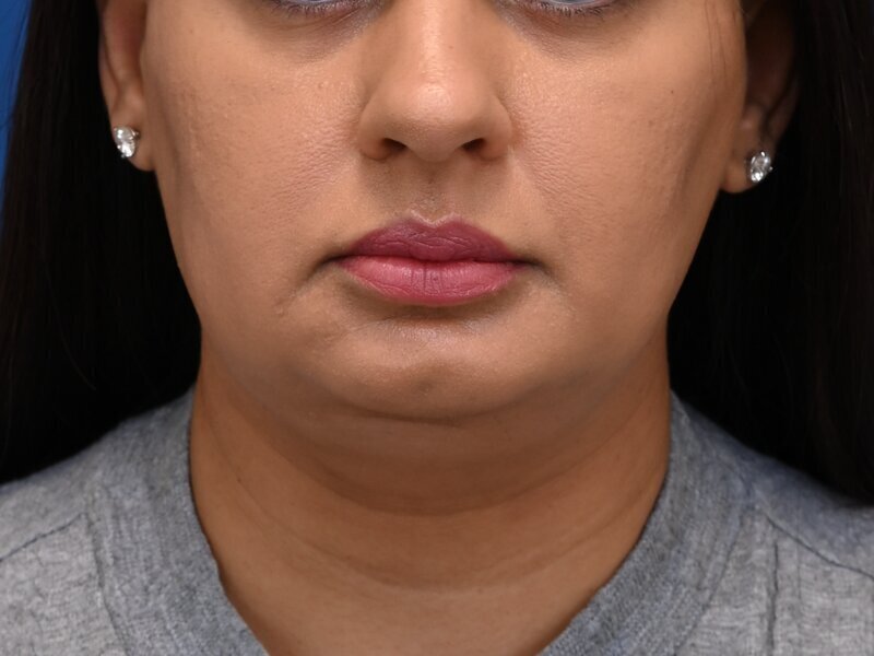 Chin Implants Before & After Image