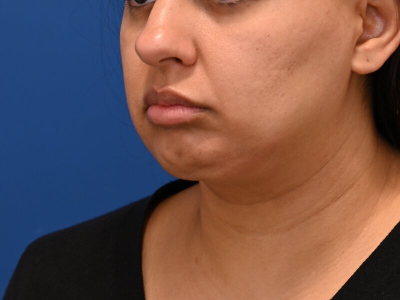 Chin Implants Before & After Image