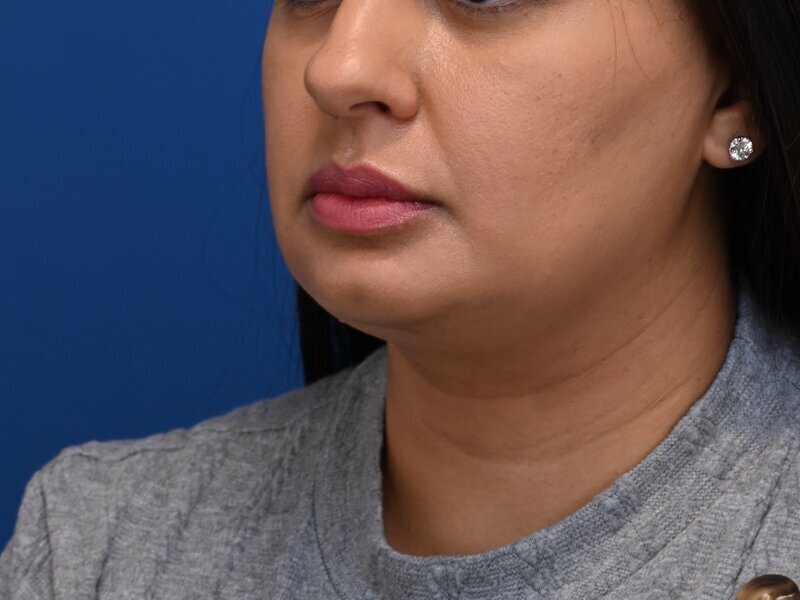Chin Implants Before & After Image
