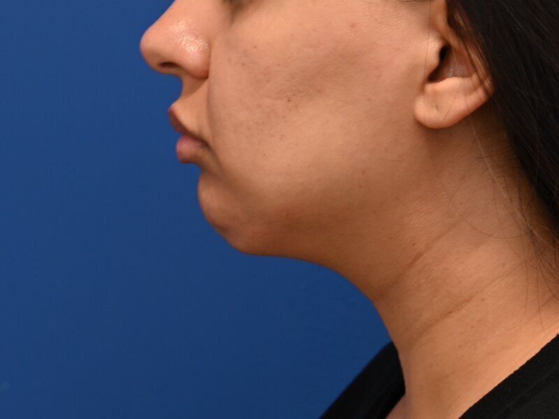 Chin Implants Before & After Image