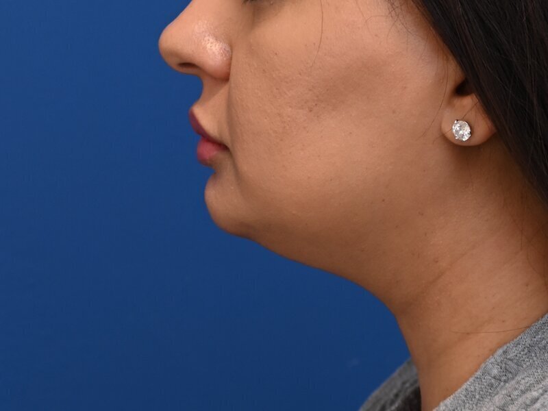 Chin Implants Before & After Image