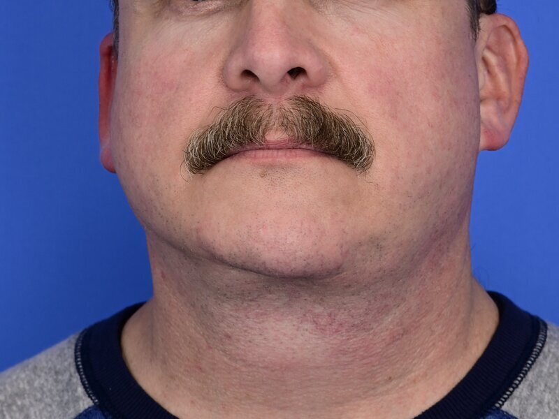 Chin Implants Before & After Image