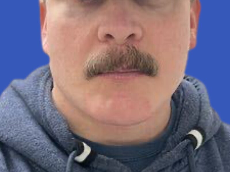 Chin Implants Before & After Image