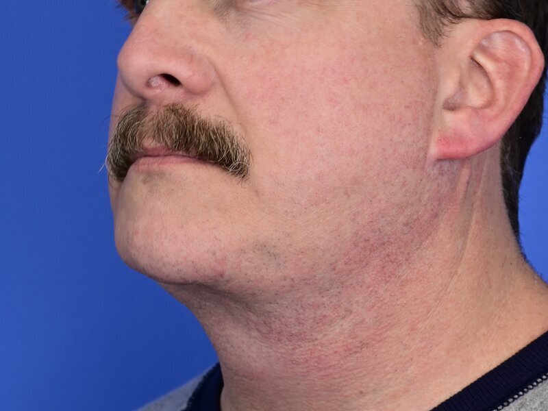 Chin Implants Before & After Image