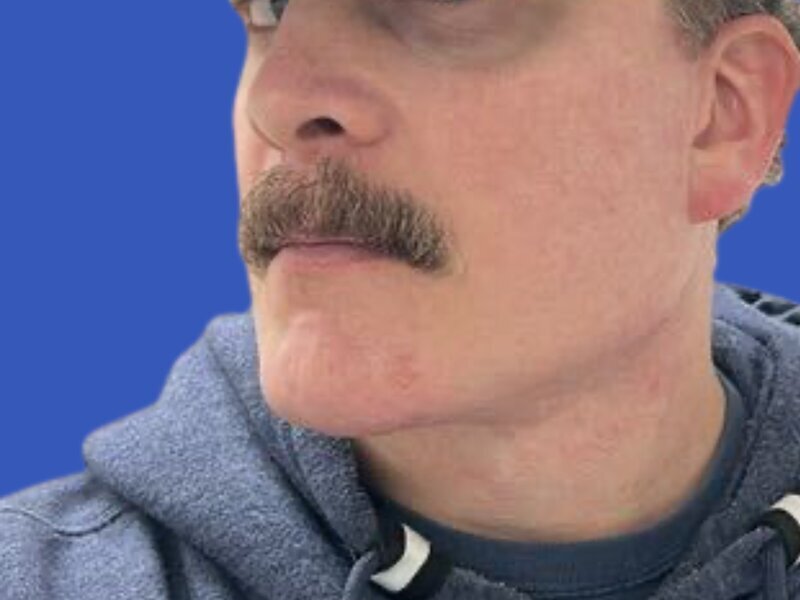 Chin Implants Before & After Image