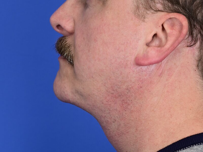 Chin Implants Before & After Image