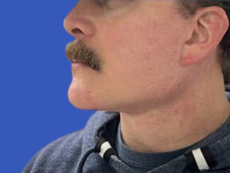 Chin Implants Before & After Image