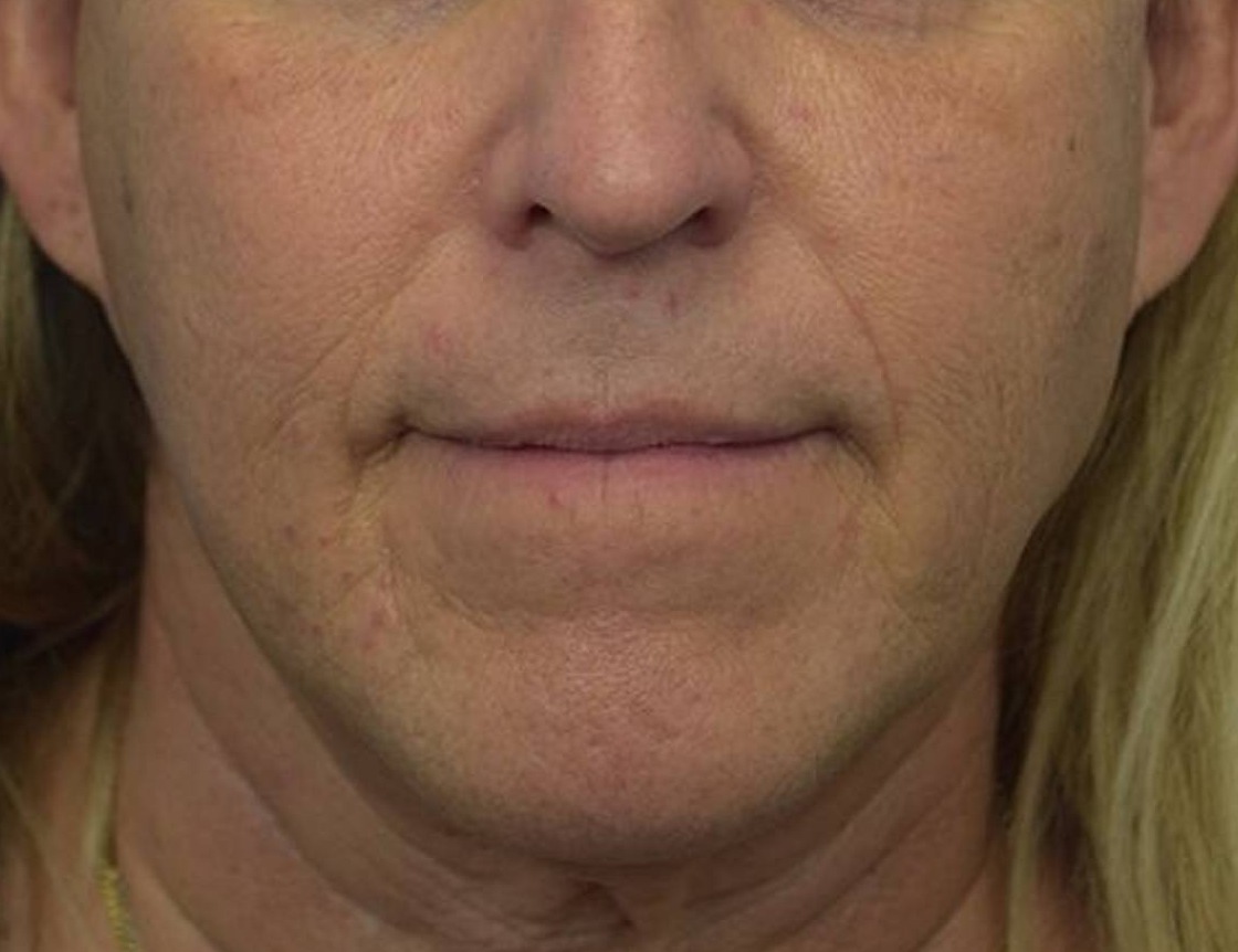 Chin Reduction Before & After Image