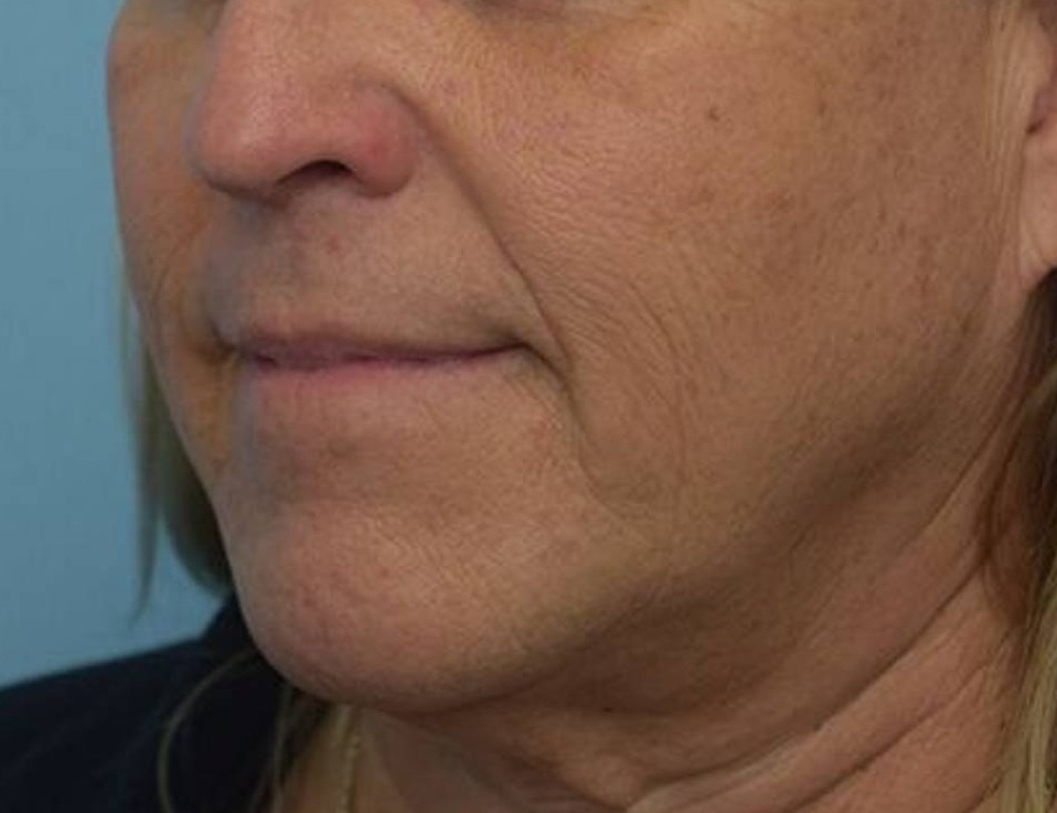 Chin Reduction Before & After Image