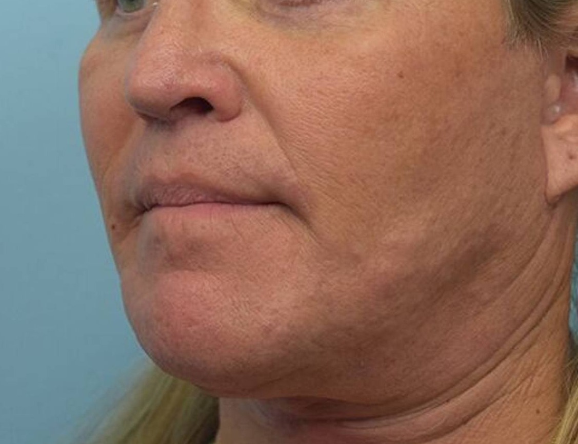 Chin Reduction Before & After Image