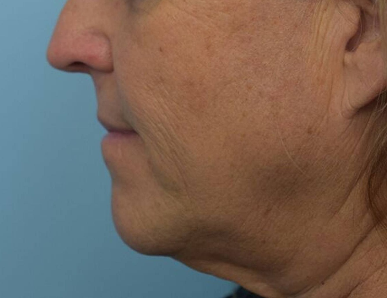 Chin Reduction Before & After Image