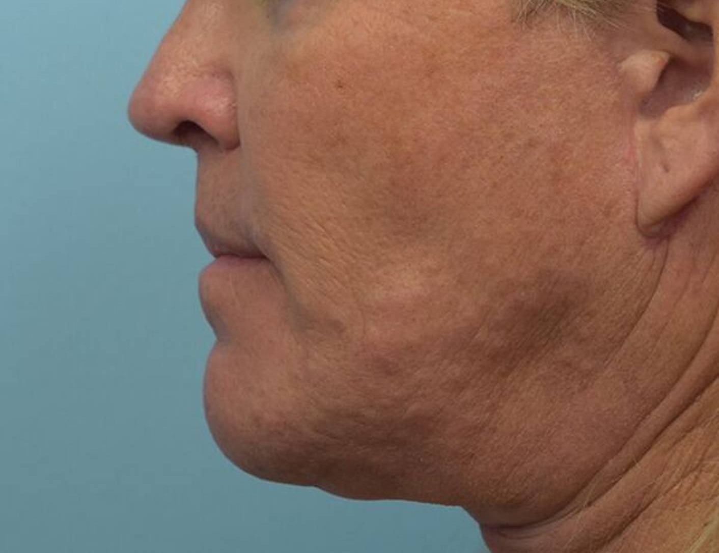 Chin Reduction Before & After Image