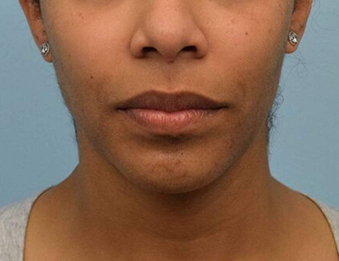 Chin Reduction Before & After Image