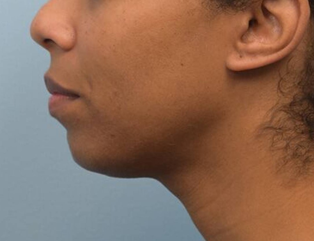 Chin Reduction Before & After Image