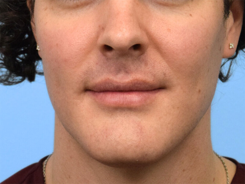 Chin Reduction Before & After Image