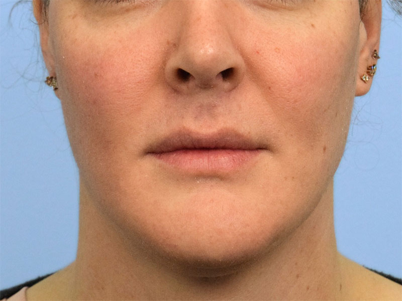 Chin Reduction Before & After Image