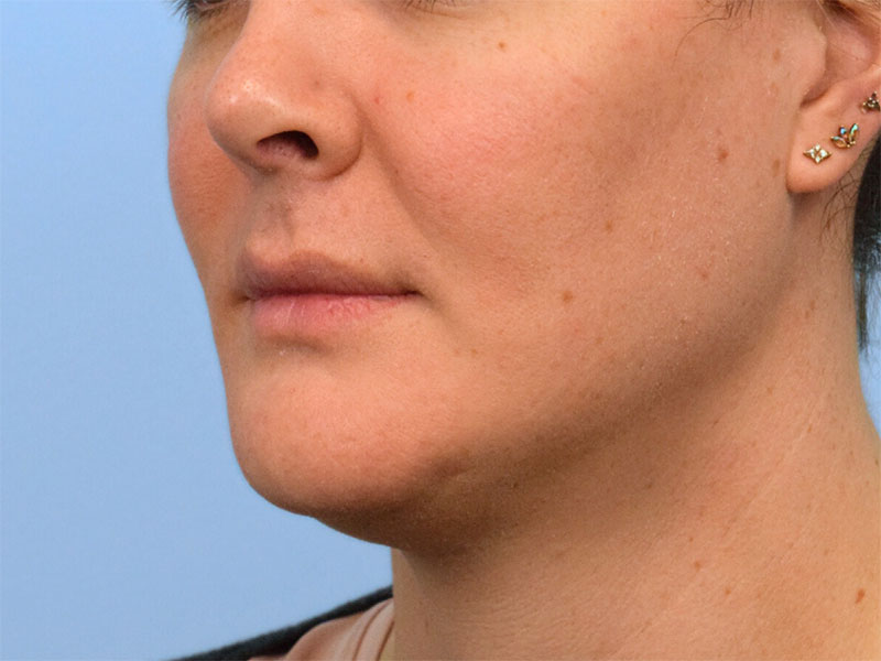 Chin Reduction Before & After Image