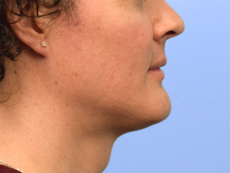 Chin Reduction Before & After Image