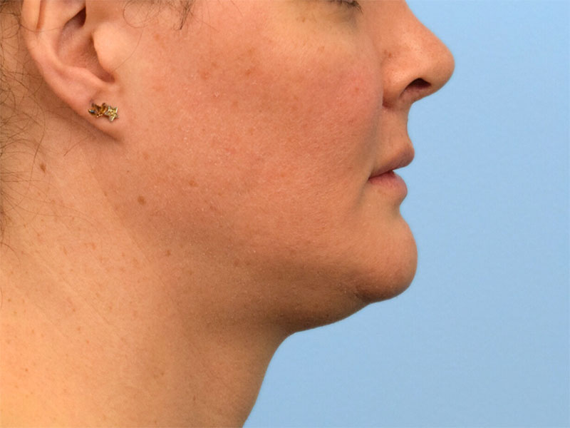 Chin Reduction Before & After Image