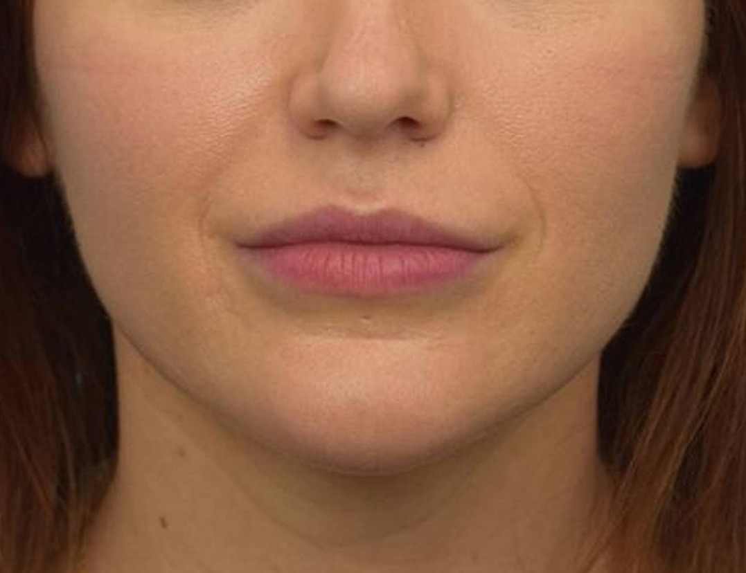 Chin Reduction Before & After Image