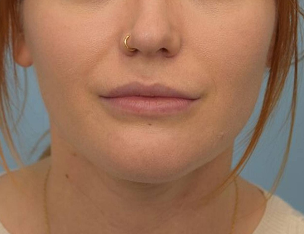 Chin Reduction Before & After Image