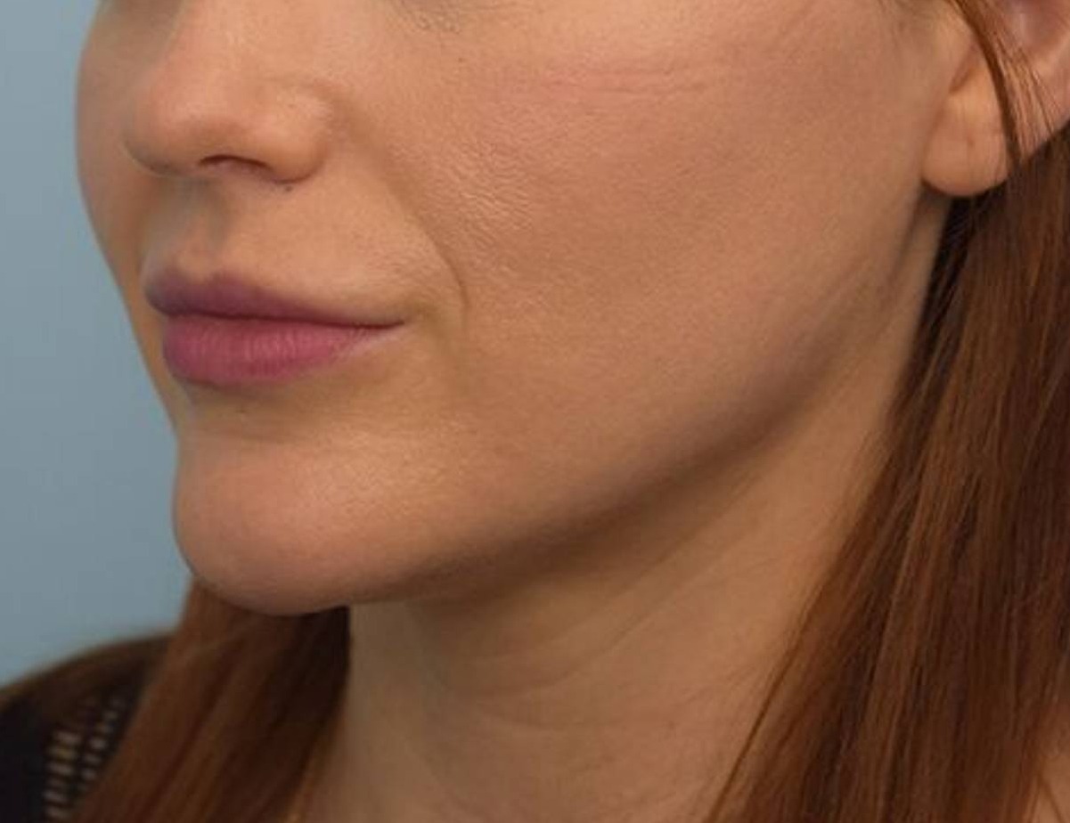 Chin Reduction Before & After Image