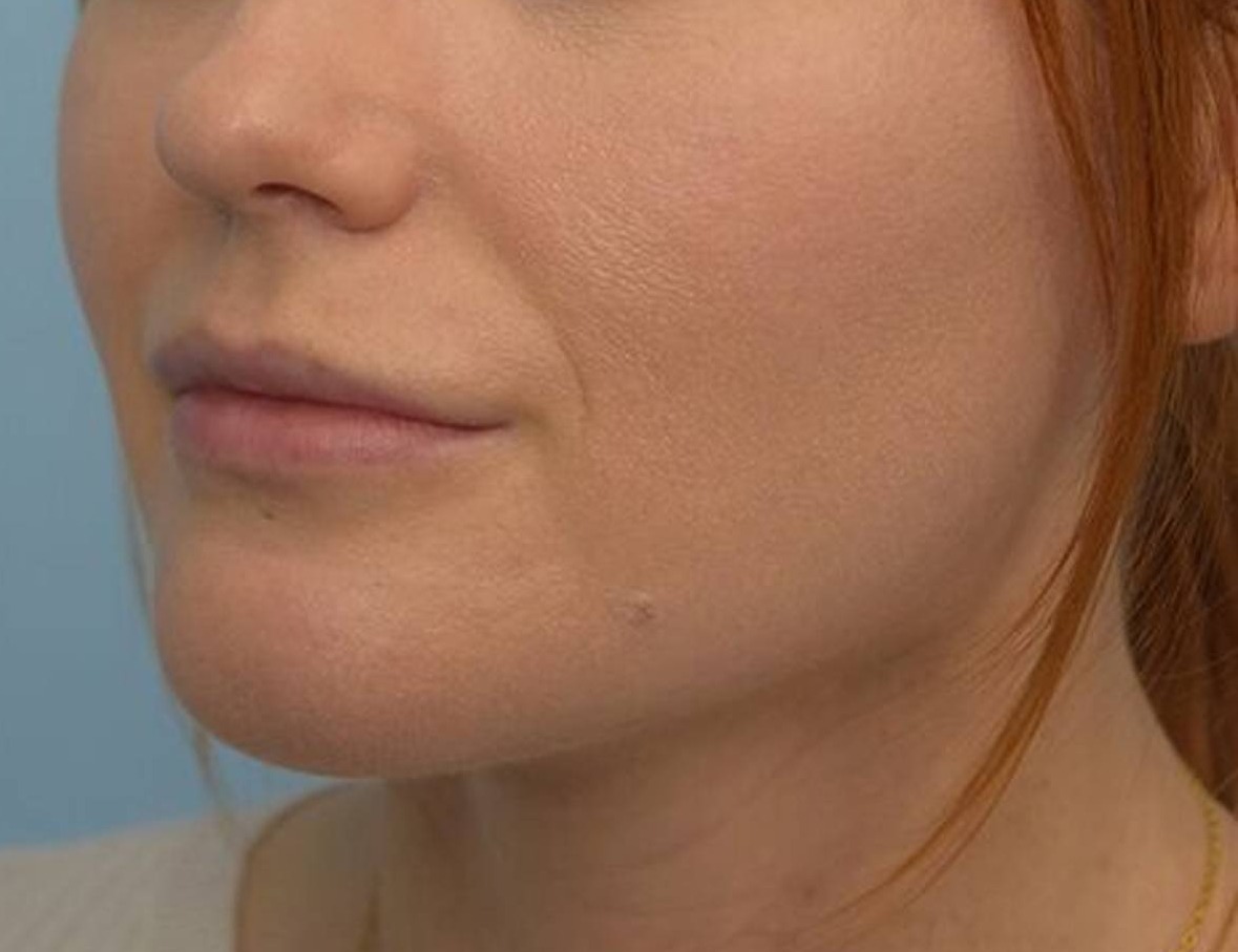 Chin Reduction Before & After Image